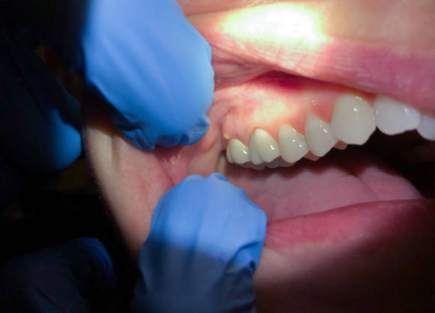 Best Emergency Gum Treatment in Middlebranch, OH