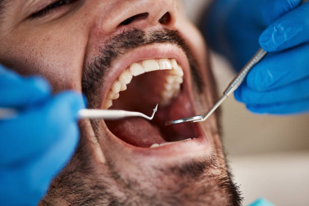 Best Emergency Tooth Extraction in Middlebranch, OH