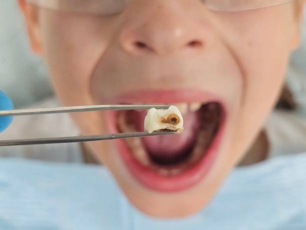 Best Emergency Wisdom Teeth Removal in Middlebranch, OH